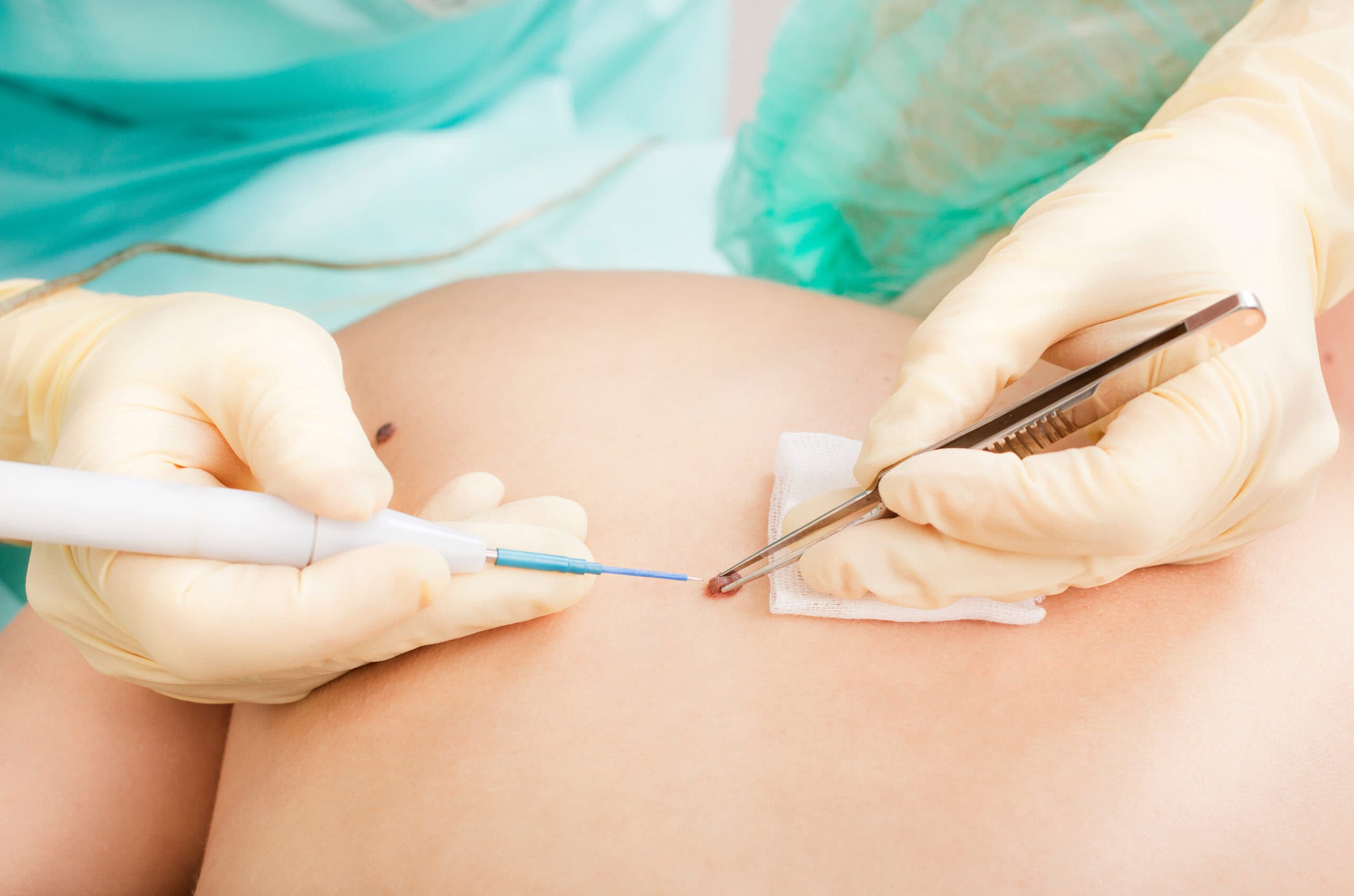 Hausarzt Praxis Söchtenau - Leistung - Dermatologie